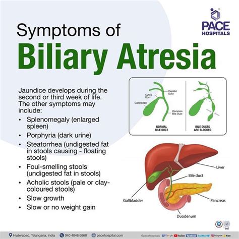 Leaking Bile Duct Symptoms, Causes, Diagnosis, and Treatment